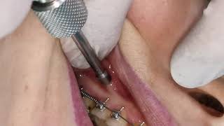 Mini screw mini implant insertion  screwing in orthodontic miniimplant TAD [upl. by Tamar]