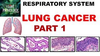 LUNG CANCER Part 1 Epidemiology Etiopathogenesis Precursor lesions amp Classification [upl. by Fredric]