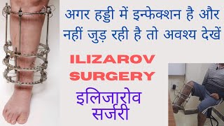 Ilizarov Surgery for bone infection and gap nonunion हड्डी के न जुड़ने और इन्फेक्शन का इलाज इलिजारोव [upl. by Meece]