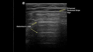 Pneumoperitoneum Enhanced Peritoneal Stripe Sign [upl. by Ahsitahs]