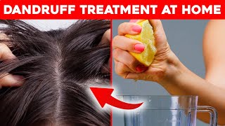 🔥1 Dandruff Treatment at Home  How to get rid of Dandruff [upl. by Ecam]