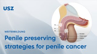 Are we too agressive  Penile preserving strategies for patients with penile cancer [upl. by Yxor]