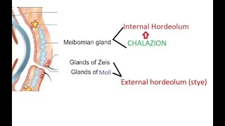 Ophthalmology 375 External hordeolum Stye Chalazion Internal Difference Compare Glands Eyelid eye [upl. by Nawoj]