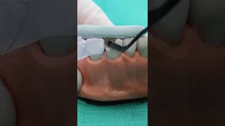 Resina dental con guia de silicón dentista resinadental odontologia dentistry [upl. by Ivana]