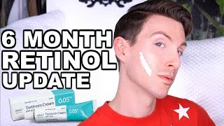 FIRST 6 MONTHS ON RETIN A  BEFORE AND AFTER TRETINOIN CREAM [upl. by Akirdna]