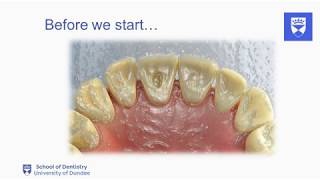 Endodontic treatment of the single rooted tooth Part 2 Access cavity preparation [upl. by Eiuqram]