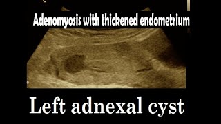 Adenomyosis  Thickened endometrium  Adnexal cyst  Amader hospital  Ultrasonography report [upl. by Haynes]