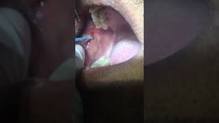 Removal of Leukoplakia Patch using RF Electrosurgery Unit Dr Ankit Goel Hapur [upl. by Esinned]