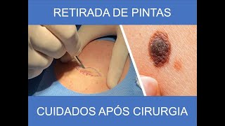 CUIDADOS APÓS CIRURGIA PARA REMOÇÃO DE PINTA [upl. by Acemaj]