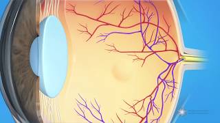 What is dry agerelated macular degeneration AMD [upl. by Richela662]