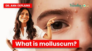 Treating MOLLUSCUM What You Need to Know [upl. by Ertnod]