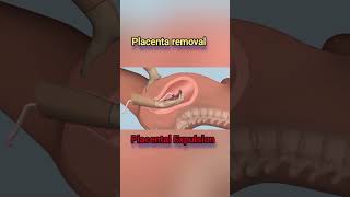 Placenta Expulsion Placentaremoval [upl. by Haidebej]