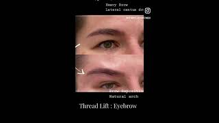 aptos thread lift for eyebrows lift threadlift eyebrowslift aptos [upl. by Zelle]