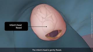 Primary vertex caesarean section Csection  TVASurg [upl. by Askwith213]