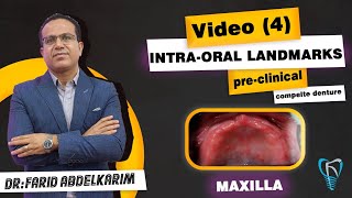 intraoral landmarks in maxilla  dr farid abdelkarim [upl. by Lynnell]