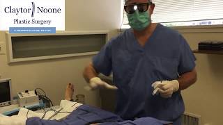 Tummy Tuck Scar Revision  Dr Claytor Fixes Tummy Tucks Scars  REAL PATIENT FOOTAGE [upl. by Leeland]