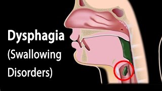 Dysphagia Animation [upl. by Frangos]