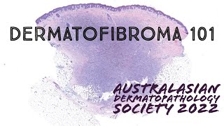 Dermatofibroma under the microscope ‪dermatology pathology dermpath USMLE [upl. by Edythe]