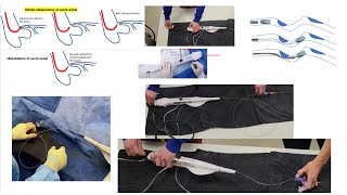 Rotational atherectomy advanced techniques with videos  Orbital atherectomy tips Elias Hanna [upl. by Hinch693]