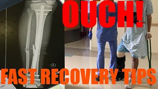 How to Recover Quickly From Broken Leg Fractured Tibia  Fibula ORIF Surgery [upl. by Brody935]