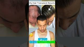 Can You Get A Hair Transplant with Retrograde Alopecia [upl. by Fesuoy]