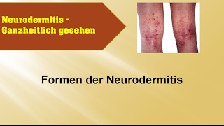 Formen der Neurodermitis  GANZMEDIZIN Naturheilpraxis [upl. by Dawna]