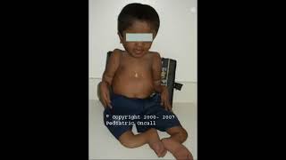 Clinical MSK Osteogenesis imperfecta [upl. by Buderus]