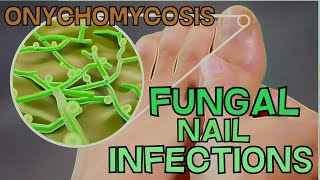 ONYCHOMYCOSIS  FUNGAL NAIL INFECTION  DEFINITION SYMPTOMS TREATMENT  EXPLAINED in 5 Minutes [upl. by Ricky]