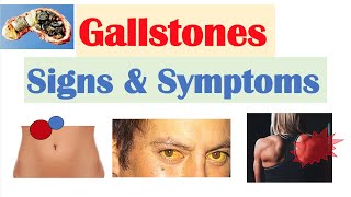 Gallstones Signs amp Symptoms Why They Occur  Cholecystitis Choledocholithiasis Cholangitis [upl. by Thorlie832]