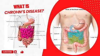 What is Crohn’s disease [upl. by Aznofla599]