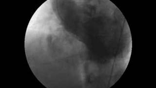 Ventricular Septal Defect seen on LV gram [upl. by Falo]