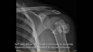 CASE 940 Soft Tissue Calcinosis in Juvenile Dermatomyositis [upl. by Acalia]