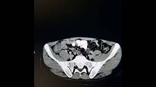 Tuberculosis involving terminal ileum ileocecal junction caecum and ascending colon [upl. by Ihsakat146]