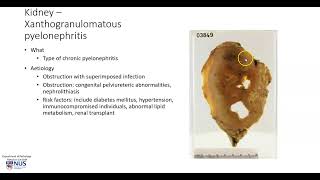 Kidney Xanthogranulomatous pyelonephritis Gross pathology [upl. by Alexa388]