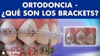 Ortodoncia – Brackets y otras partes del aparato dental © [upl. by Zimmermann]