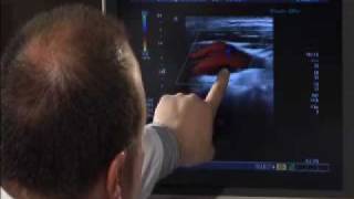 Carotid Artery Ultrasound [upl. by Addie410]