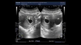 A Blighted ovum also known as anembryonic pregnancy [upl. by Rosol723]