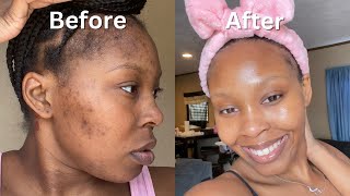 How I Cleared My Acne  Dark Spots  Hyperpigmentation for good in 1 month NO ACCUTANE VIDEO PROOF [upl. by Fredric]