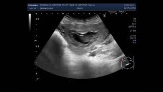 Ultrasound Video showing Blighted ovum with endometrial polyp [upl. by Lajib]