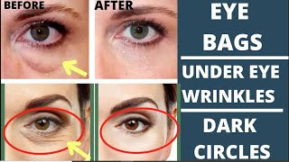 🛑 BEST ANTIAGING FACE EXERCISES FOR EYE BAGS DARK CIRCLES EYE WRINKLES  LIFT DROOPY EYELIDS [upl. by Milde384]