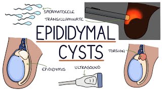 Understanding Epididymal Cysts [upl. by Apur541]