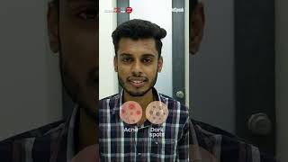 Two Months to Clear Skin An Inspiring Transformation Story  Clear Skin Clinic Pune [upl. by Aneetsyrk]