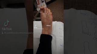 CRAZY BUNION TRANSFORMATION short viralshorts bunions painlesssurgery recovery beforeandafter [upl. by Hanoj807]