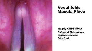 Vocal folds Macula Flava [upl. by Anyah]