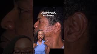 Causes of Brown Bumps on the Face Dermatosis Papulosa Nigra DPN and Treatment [upl. by Alemaj]