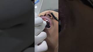 Pyogenic granuloma gum  Dr Hitesh Patel [upl. by Nyre]