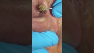 Monster Blackhead In Ear 01 [upl. by Ganny]