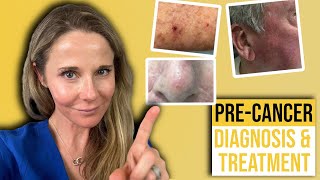 Actinic keratosis treatment guide from a Dermatologist [upl. by Nosretep618]