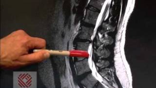 Low Back Pain Part 8 Spinal Stenosis [upl. by Hgielanna]