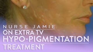 Hypopigmentation Treatment  Nurse Jamie on Extra TV [upl. by Salzhauer]